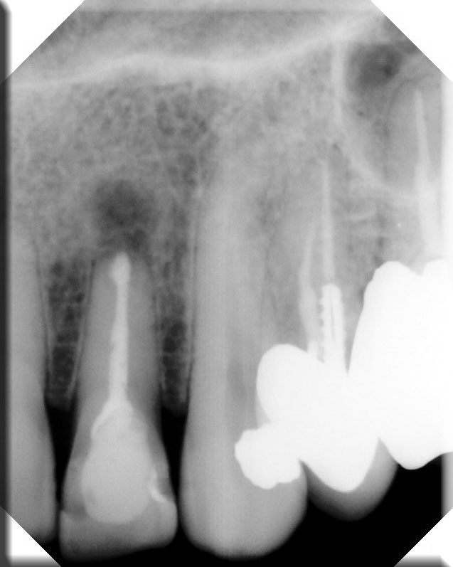 Apicectomy1 Xray3web .jpg